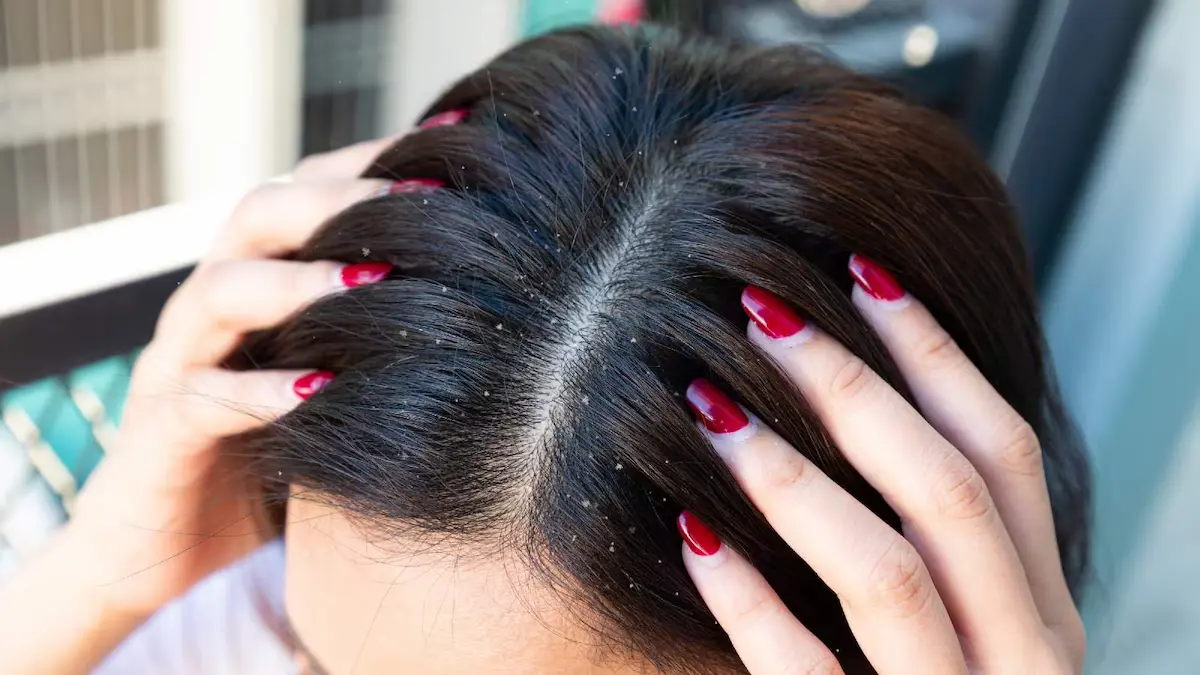 5 Remedies That Heal Your Scalp